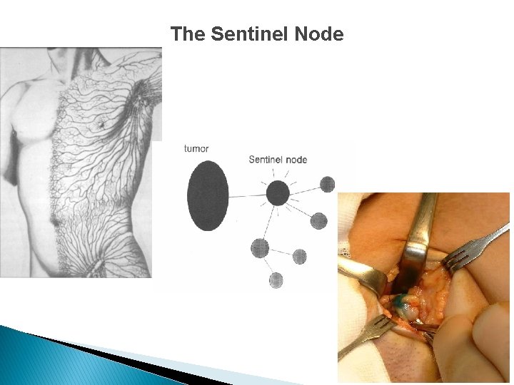 The Sentinel Node 
