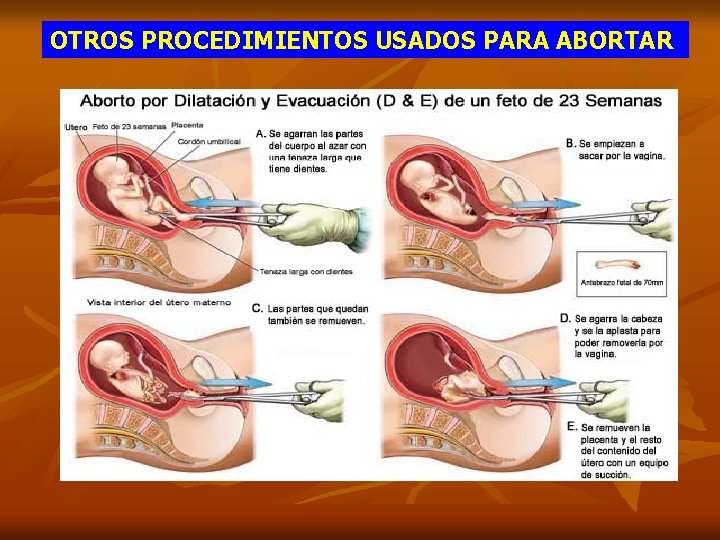 OTROS PROCEDIMIENTOS USADOS PARA ABORTAR 