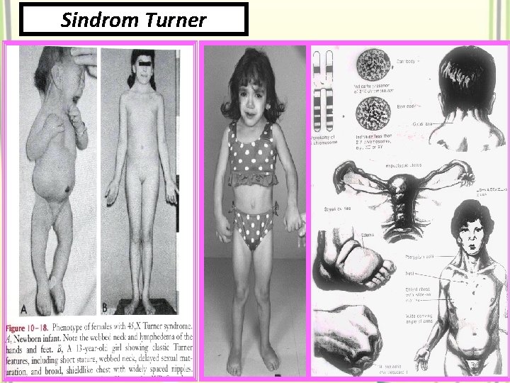 Sindrom Turner 36 