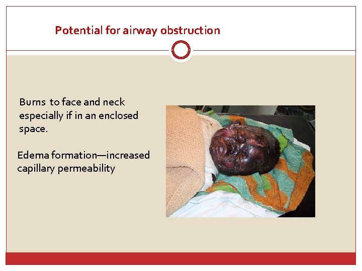 Potential for airway obstruction Burns to face and neck especially if in an enclosed