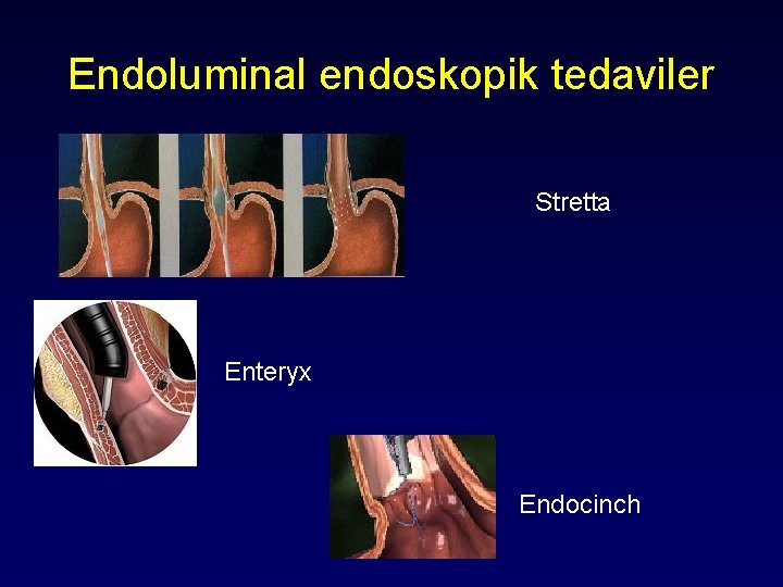 Endoluminal endoskopik tedaviler Stretta Enteryx Endocinch 