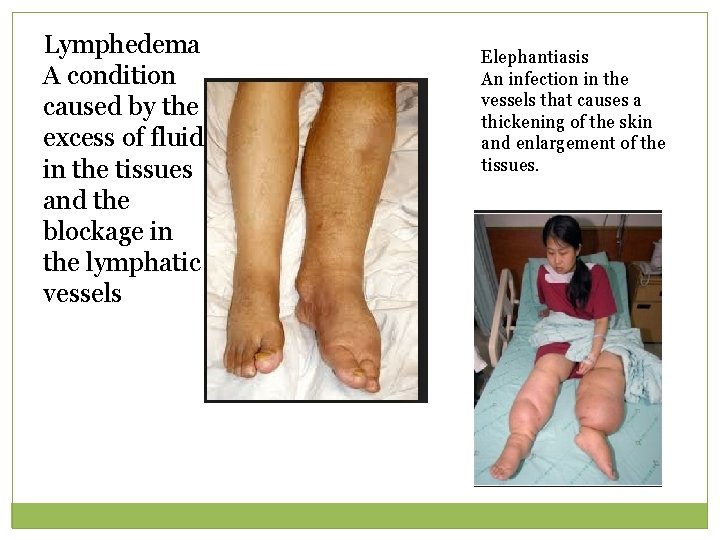 Lymphedema A condition caused by the excess of fluid in the tissues and the