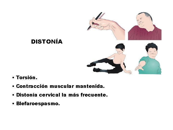 DISTONÍA • Torsión. • Contracción muscular mantenida. • Distonía cervical la más frecuente. •