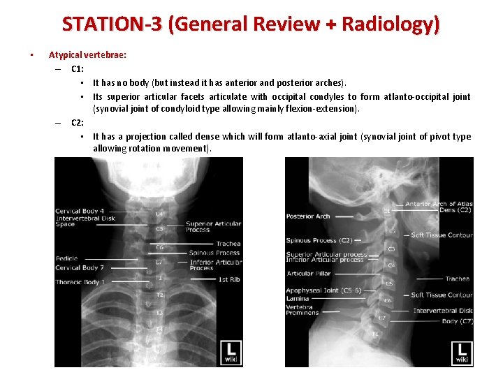 STATION-3 (General Review + Radiology) • Atypical vertebrae: – C 1: • It has