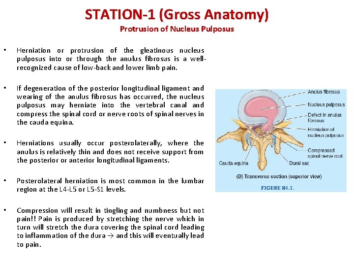 STATION-1 (Gross Anatomy) Protrusion of Nucleus Pulposus • Herniation or protrusion of the gleatinous