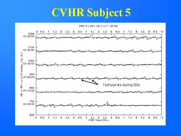 CVHR Subject 5 Tachycardia during OSA 