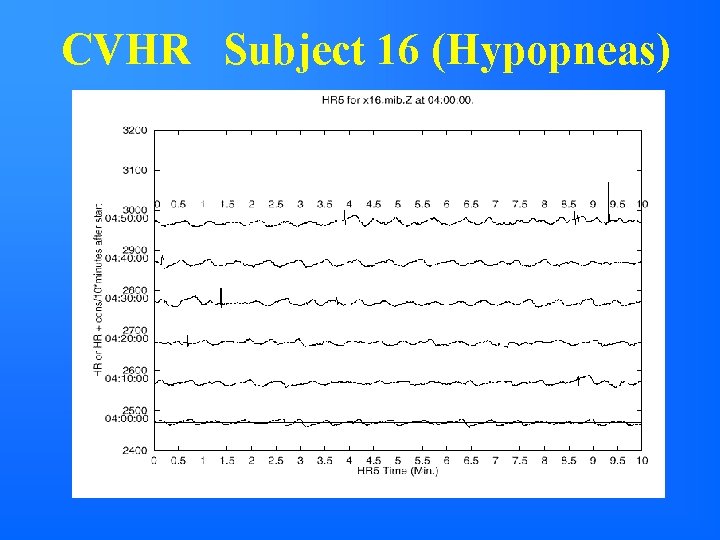 CVHR Subject 16 (Hypopneas) 