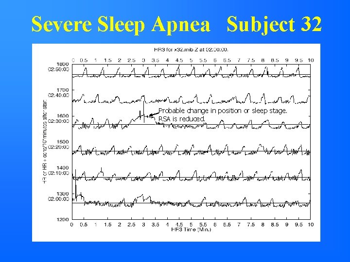 Severe Sleep Apnea Subject 32 Probable change in position or sleep stage. RSA is