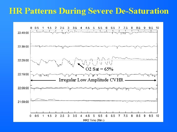 HR Patterns During Severe De-Saturation O 2 Sat = 65% Irregular Low Amplitude CVHR