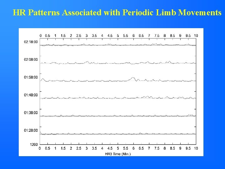 HR Patterns Associated with Periodic Limb Movements 