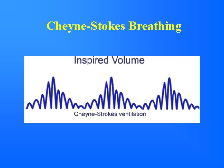 Cheyne-Stokes Breathing 