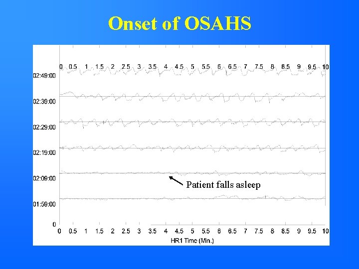 Onset of OSAHS Patient falls asleep 