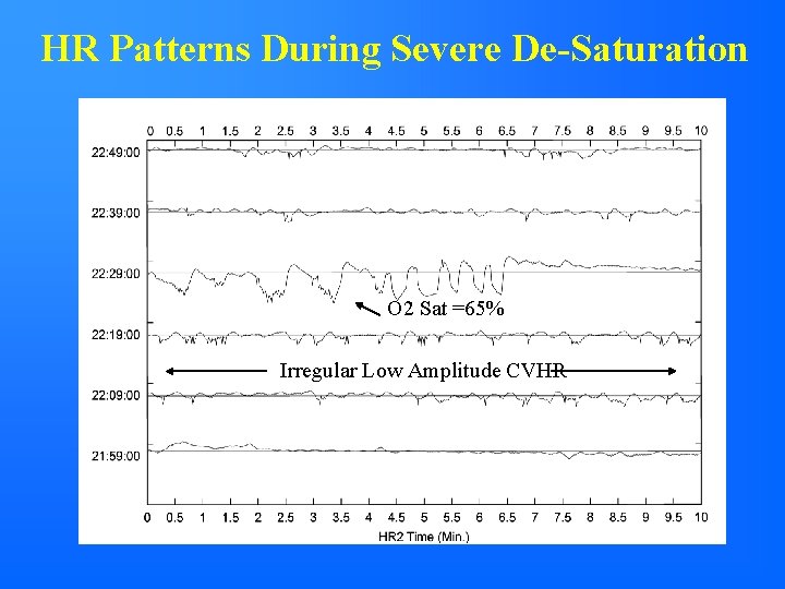 HR Patterns During Severe De-Saturation O 2 Sat =65% Irregular Low Amplitude CVHR 