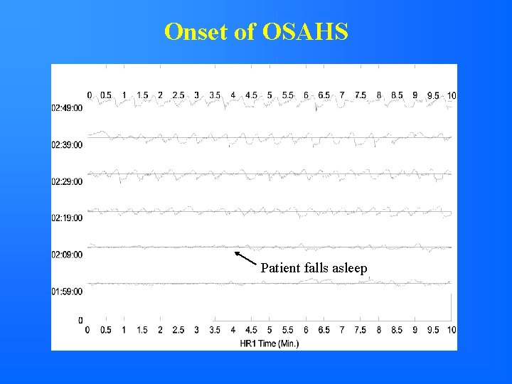 Onset of OSAHS Patient falls asleep 