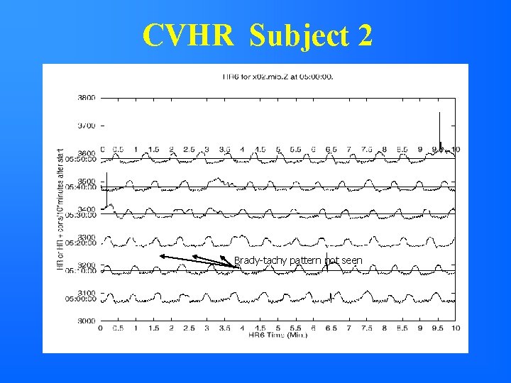 CVHR Subject 2 Brady-tachy pattern not seen 