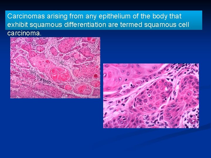 Carcinomas arising from any epithelium of the body that exhibit squamous differentiation are termed
