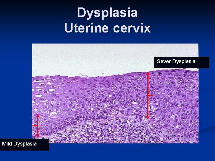 Dysplasia Uterine cervix Sever Dysplasia Mild Dysplasia 