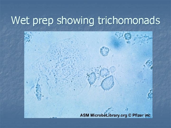 Wet prep showing trichomonads 