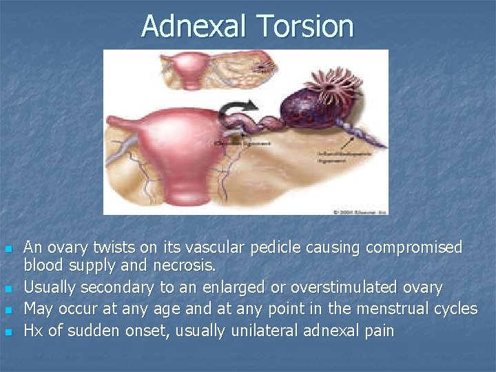 Adnexal Torsion n n An ovary twists on its vascular pedicle causing compromised blood