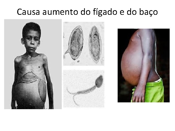 Causa aumento do fígado e do baço 