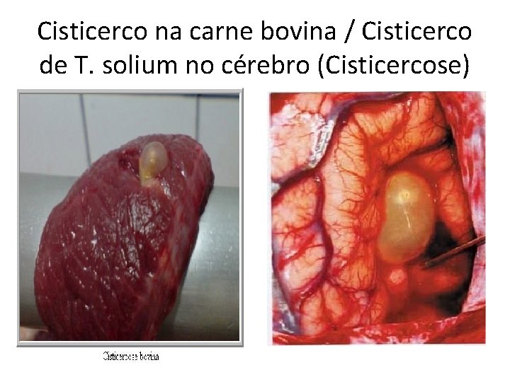 Cisticerco na carne bovina / Cisticerco de T. solium no cérebro (Cisticercose) 