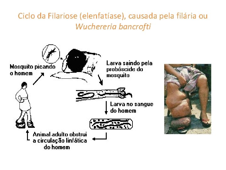 Ciclo da Filariose (elenfatíase), causada pela filária ou Wuchereria bancrofti 