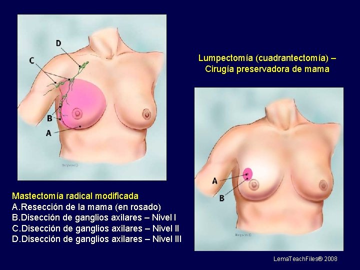 Lumpectomía (cuadrantectomía) – Cirugía preservadora de mama Mastectomía radical modificada A. Resección de la