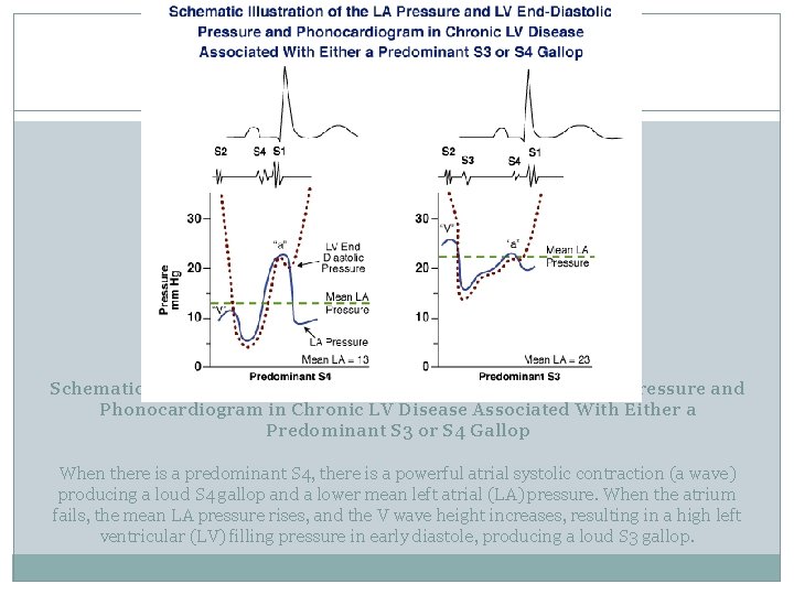 Schematic Illustration of the LA Pressure and LV End-Diastolic Pressure and Phonocardiogram in Chronic