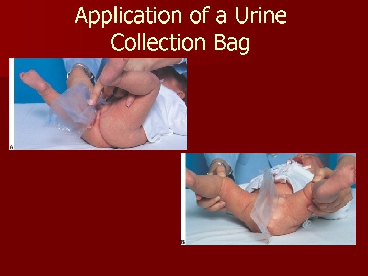 Application of a Urine Collection Bag 