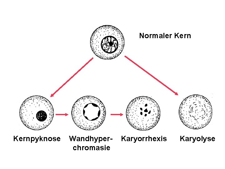 Normaler Kernpyknose Wandhyperchromasie Karyorrhexis Karyolyse 