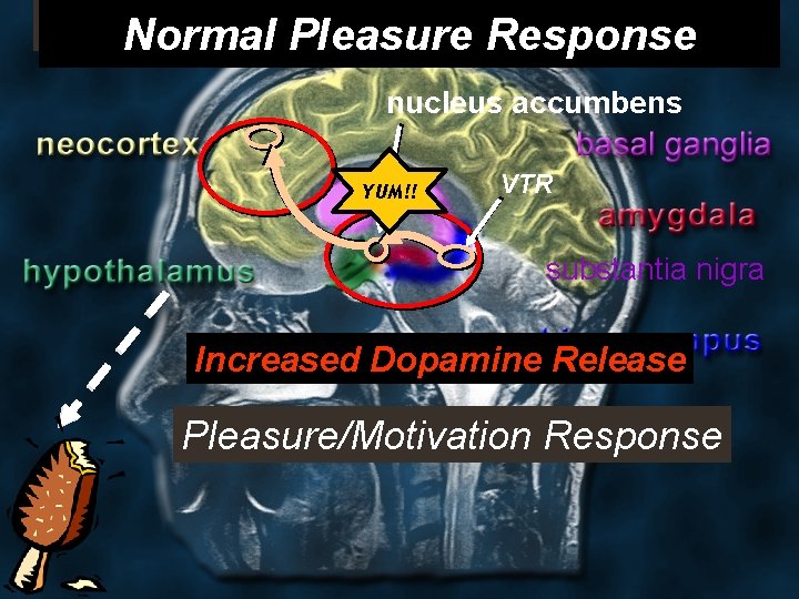  Normal Pleasure Response nucleus accumbens YUM!! VTR substantia nigra Increased Dopamine Release locus