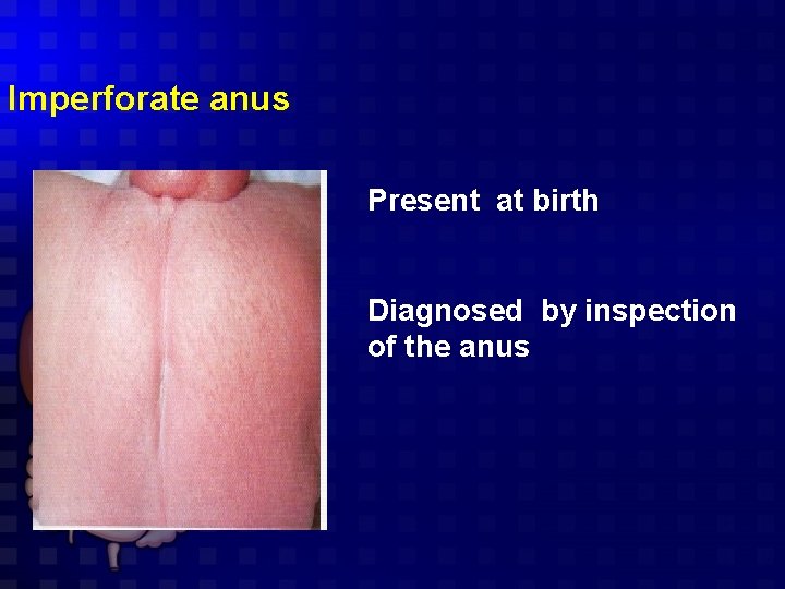 Imperforate anus Present at birth Diagnosed by inspection of the anus 