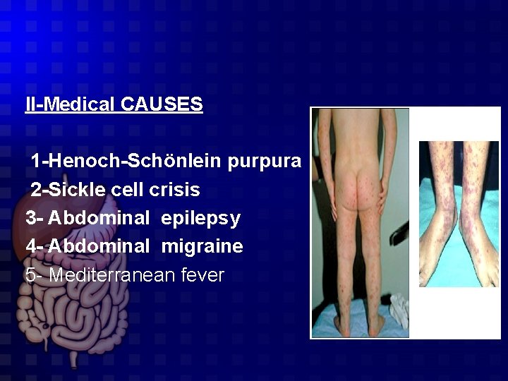 II-Medical CAUSES 1 -Henoch-Schönlein purpura 2 -Sickle cell crisis 3 - Abdominal epilepsy 4