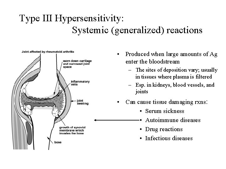 Type III Hypersensitivity: Systemic (generalized) reactions • Produced when large amounts of Ag enter
