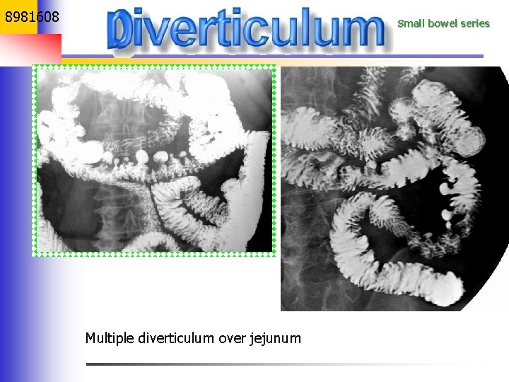 8981608 Small bowel series Multiple diverticulum over jejunum 