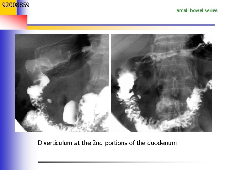 92008859 Small bowel series Diverticulum at the 2 nd portions of the duodenum. 