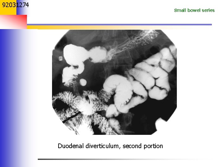 92031274 Small bowel series Duodenal diverticulum, second portion 