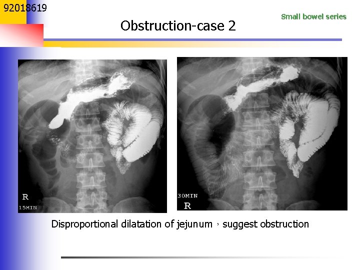 92018619 Obstruction-case 2 Small bowel series Disproportional dilatation of jejunum，suggest obstruction 