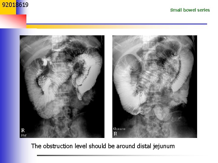 92018619 Small bowel series The obstruction level should be around distal jejunum 