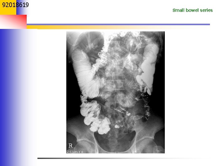 92018619 Small bowel series 