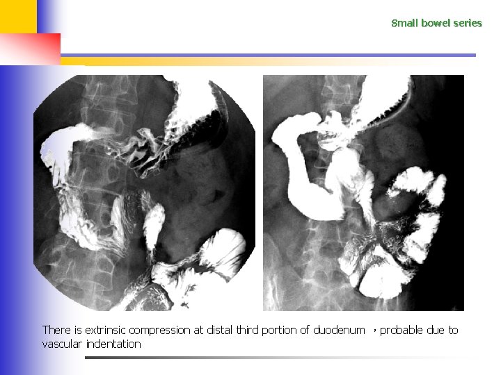 Small bowel series There is extrinsic compression at distal third portion of duodenum ，probable