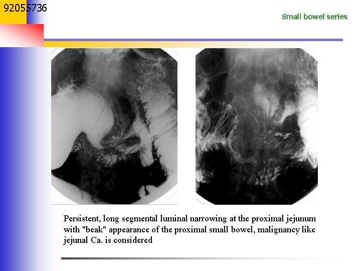 92055736 Small bowel series Persistent, long segmental luminal narrowing at the proximal jejunum with