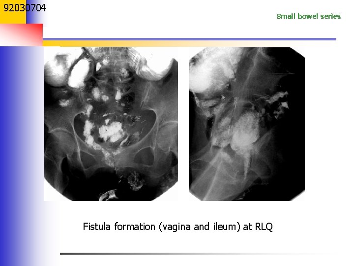 92030704 Small bowel series Fistula formation (vagina and ileum) at RLQ 