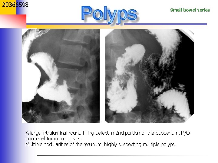 20366598 Small bowel series A large intraluminal round filling defect in 2 nd portion