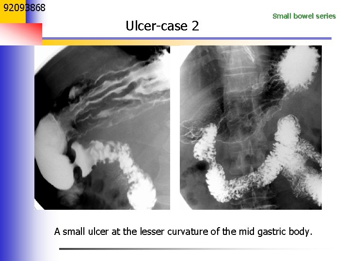 92093868 Ulcer-case 2 Small bowel series A small ulcer at the lesser curvature of