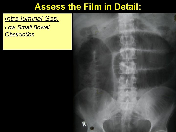 Assess the Film in Detail: Intra-luminal Gas: Low Small Bowel Obstruction Small Bowel obstruction.