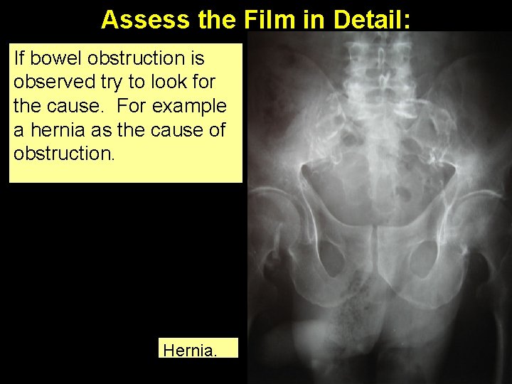 Assess the Film in Detail: If bowel obstruction is observed try to look for