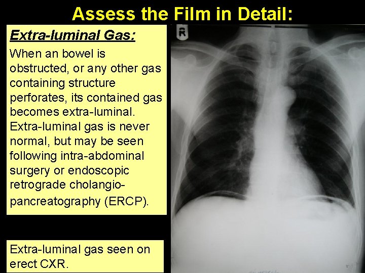 Assess the Film in Detail: Extra-luminal Gas: When an bowel is obstructed, or any