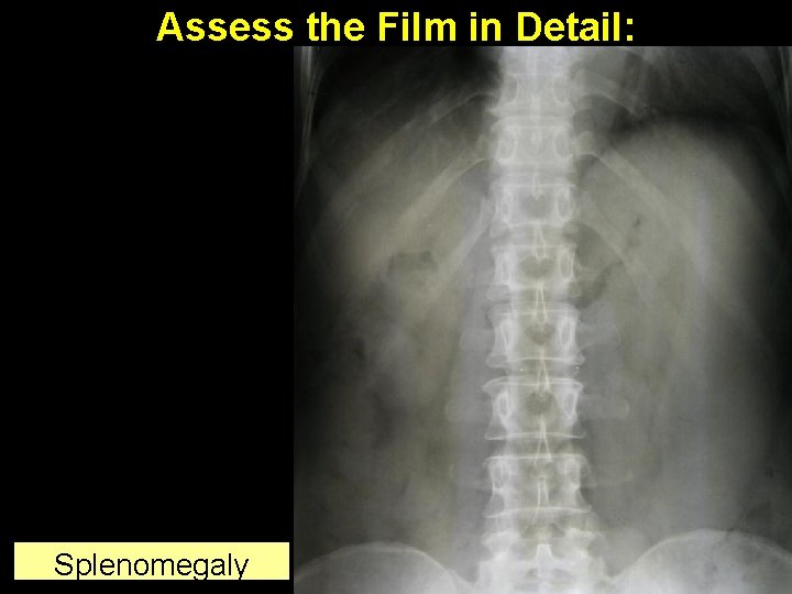 Assess the Film in Detail: Splenomegaly 