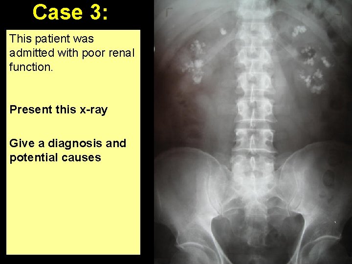 Case 3: This patient was admitted with poor renal function. Present this x-ray Give